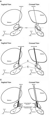 Microstimulation Is a Promising Approach in Achieving Better Lead Placement in Subthalamic Nucleus Deep Brain Stimulation Surgery